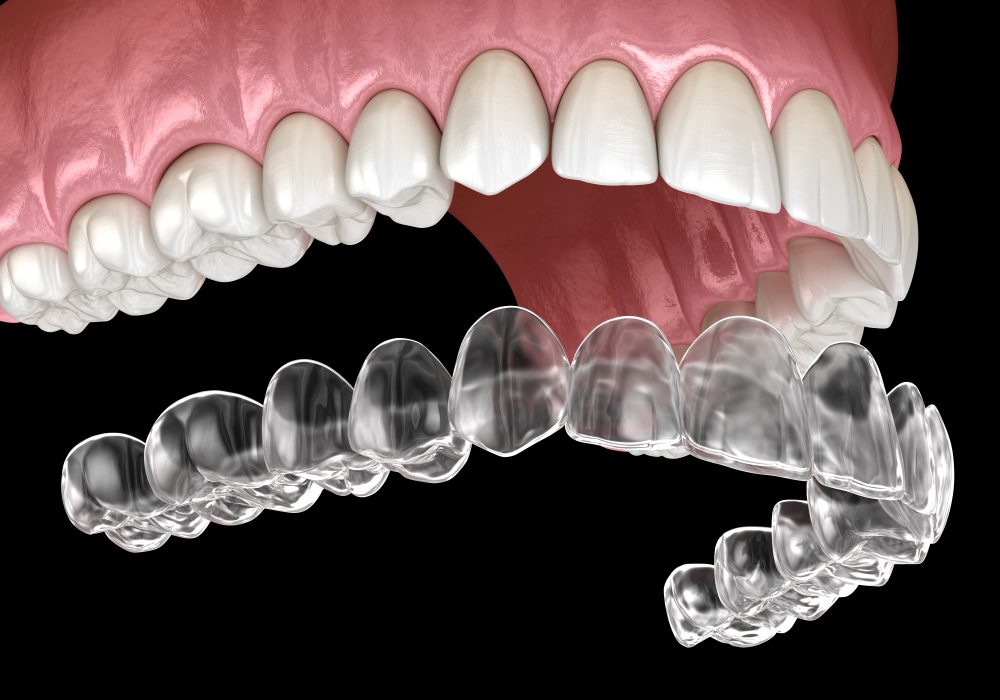Invisalign Orthodontics Treatment Birmingham