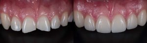 Composite Bonding in Birmingham - A Guide for You 3 Composite Bonding Chipped