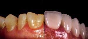 Composite Bonding in Birmingham - A Guide for You 2 Composite Bonding before after