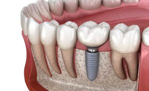 Dental Implants in Birmingham - What are they and how do they work 2 Understanding Dental Implants