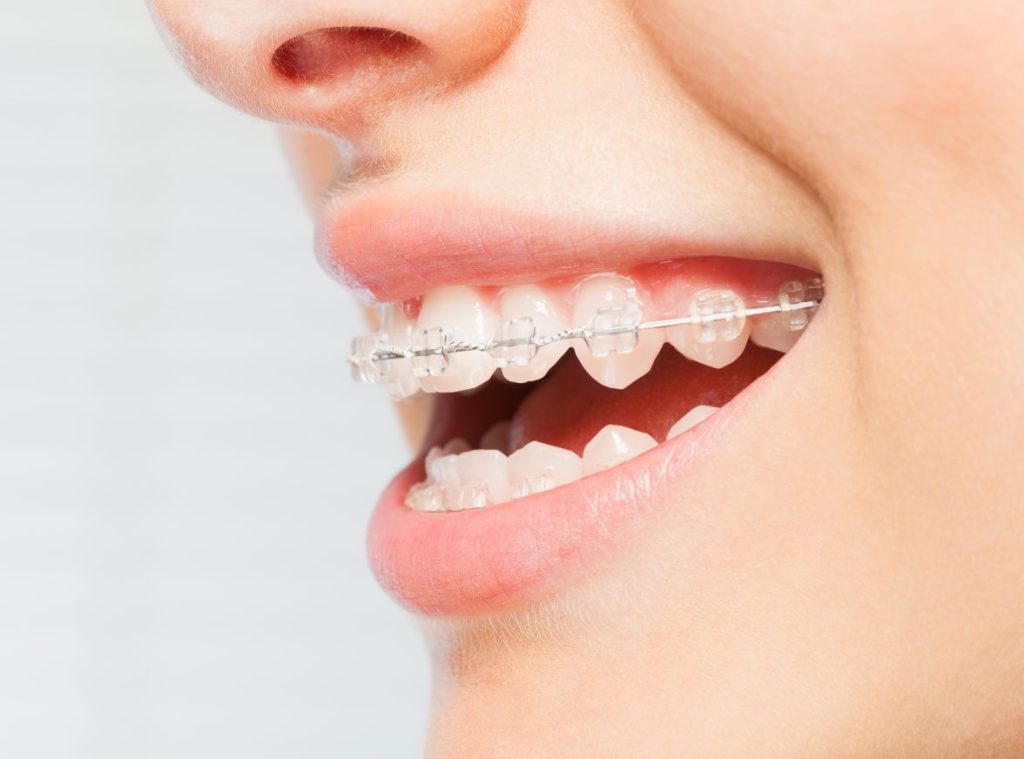 Clear braces in Birmingham