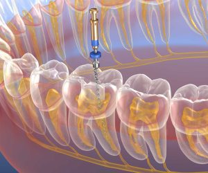 Root Canal Treatment in Birmingham- Everything You Need to Know 2 What is Root Canal Treatment?