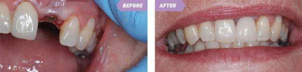 All on 4 Dental Implants 9 Birmingham Teeth in a day
