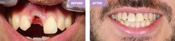 Implant Treatment Process 2 Birmingham Dental Implants