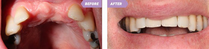 All on 4 Dental Implants 12 all on 4 implants birmingham