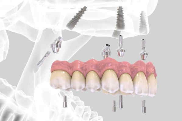 All on 4 Implants Birmingham