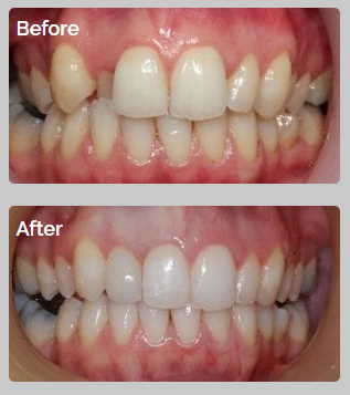 All Orthodontics Options 10 04 24 28 case2