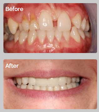 All Orthodontics Options 10 04 24 29 case3
