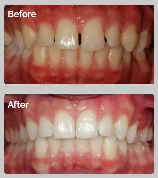 All Orthodontics Options 10 04 24 30 case4