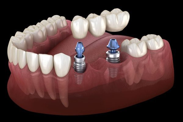 Single Dental Implant 6 implant supported bridge in Birmingham