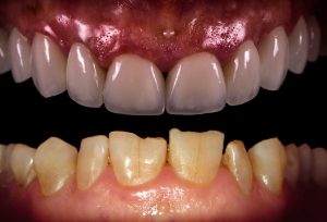 Porcelain Veneers vs Composite Bonding 2 porcelain veneers vs composite bonding