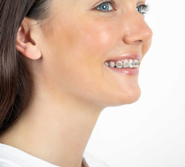 Fixed Metal and Ceramic Braces 5 orthodontics in birmingham