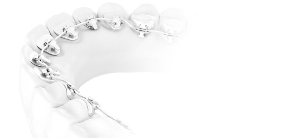 Lingual Braces in Birmingham